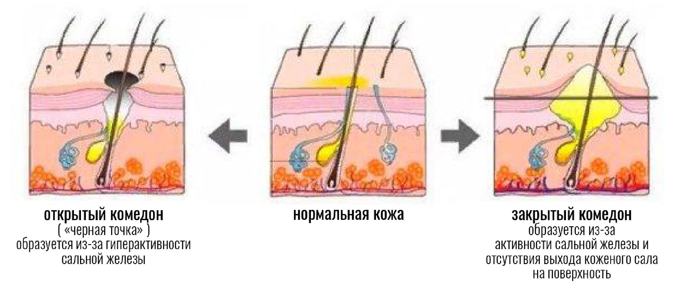 Точка закрыть. Акне кожа схема сальные железы. Открытые комедоны схема. Открытый и закрытый комедон.