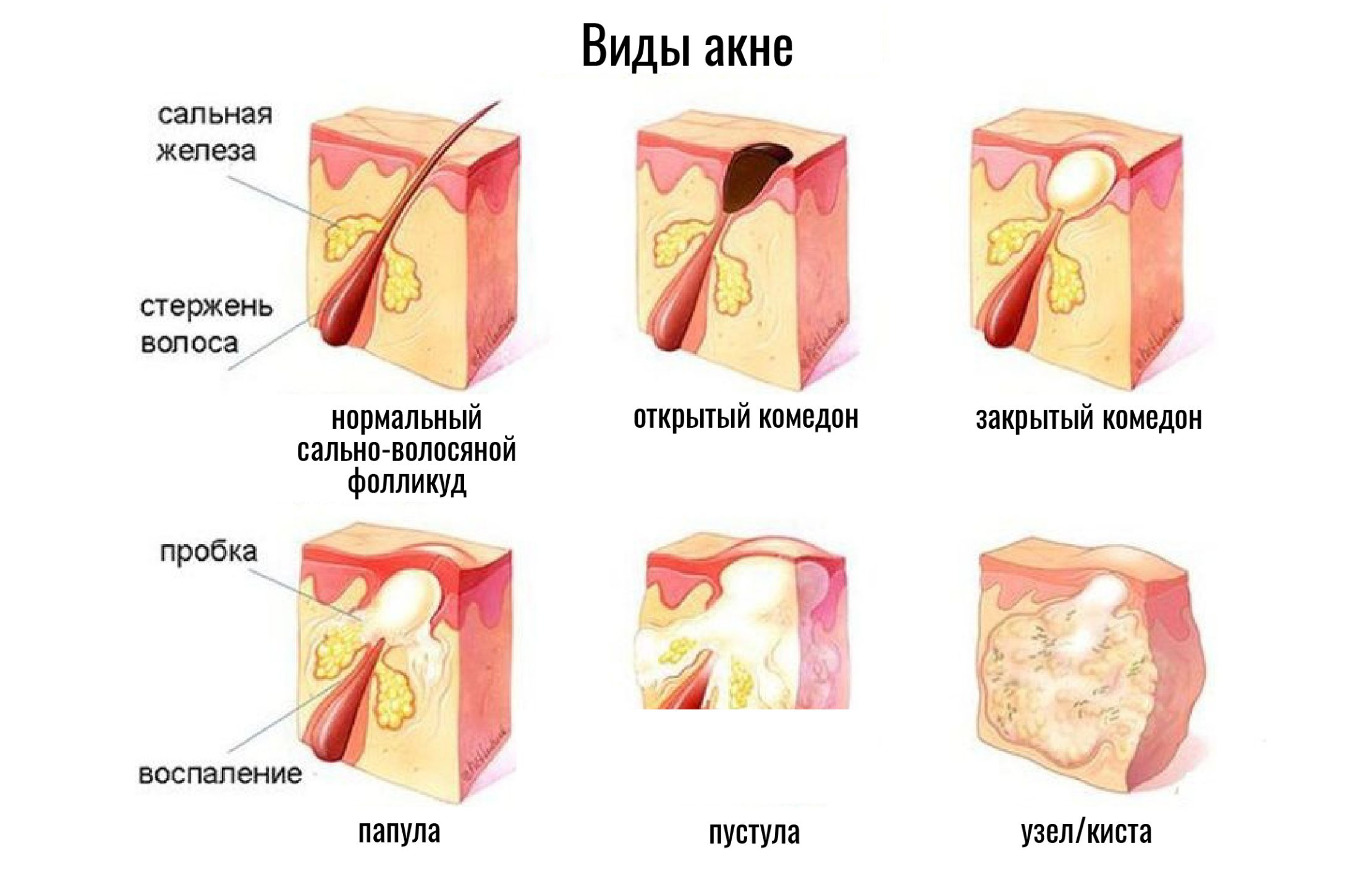 Виды Прыщей У Детей Фото